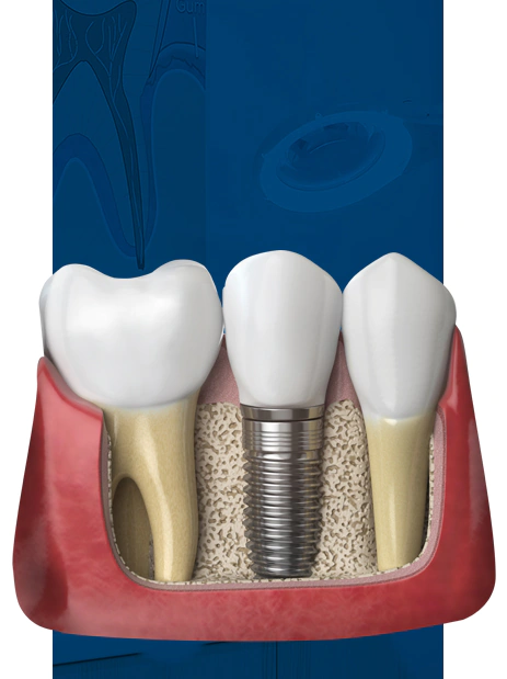 periodontal disease