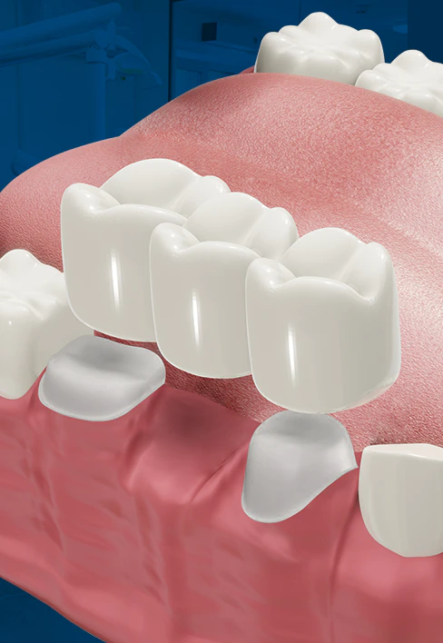 dental bridge