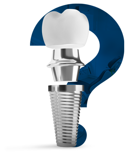 What is a dental implant