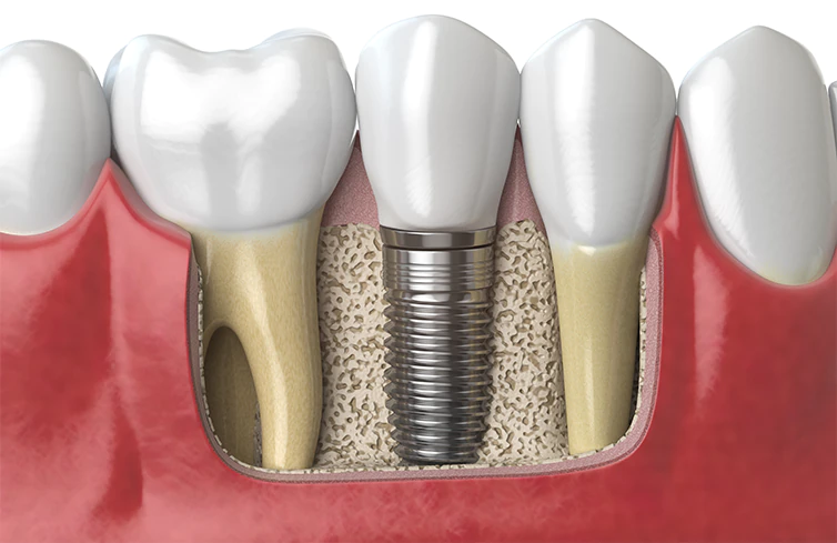 Dental implants procedure